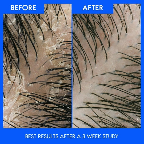 Head & Shoulders Deep Scalp Cleanse 2-in-1 Anti-Dandruff Shampoo + Conditioner, 370ML