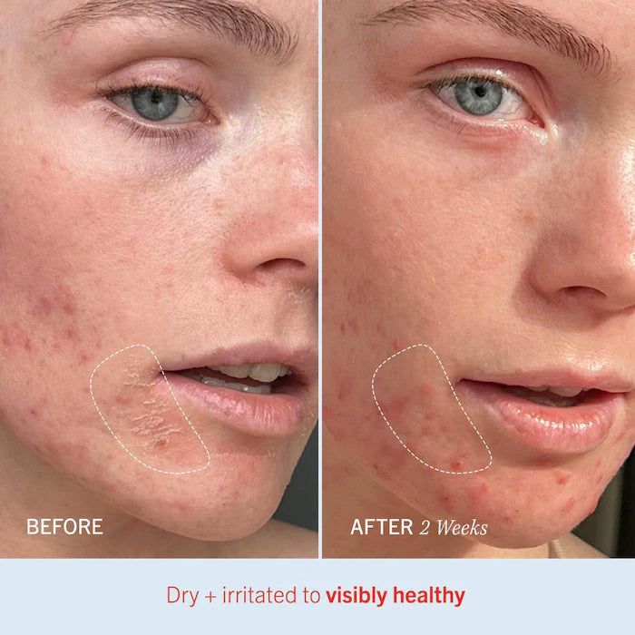 First Aid Beauty  Ultra Repair® Cream Intense Hydration – Face and Body Moisturizer for Skin Repair